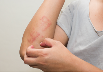 Dermatite: cause, consigli e rimedi